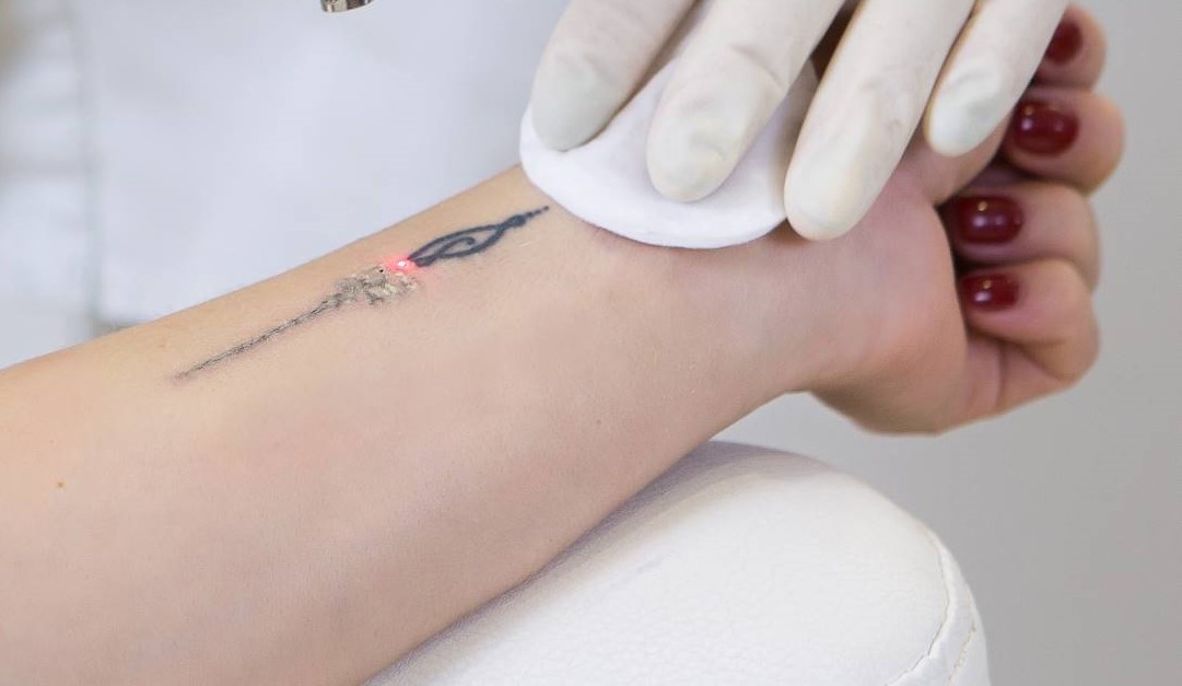 Funcionamiento del pico laser
